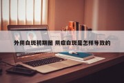 外阴白斑初期图 阴症白斑是怎样导致的