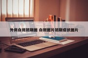 外阴白斑初期图 白斑图片初期症状图片